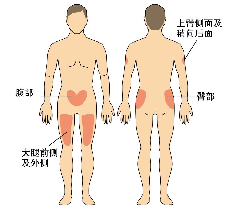 如何选择注射部位?