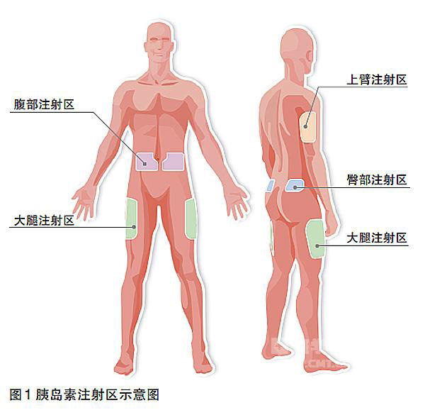人体适合皮下注射胰岛素的部位有腹部,大腿,上臂,臀部等位置,其中腹部